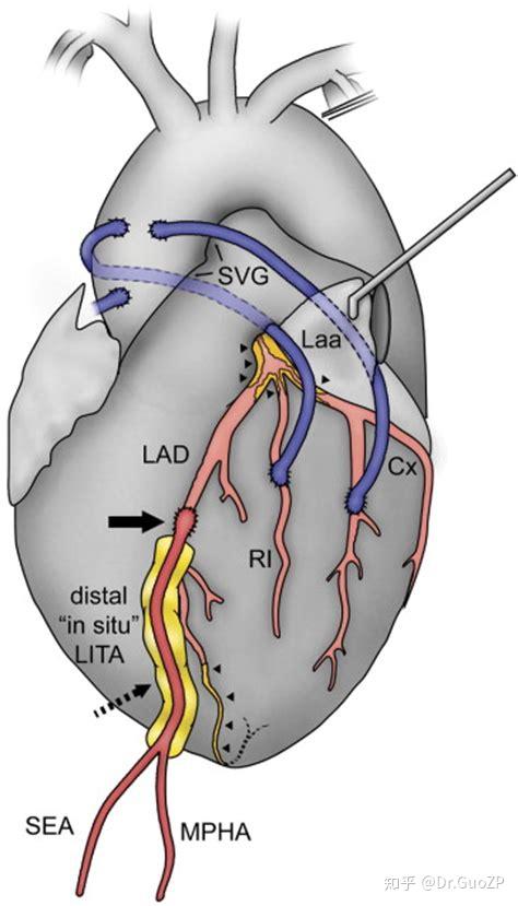 大隐静脉搭桥是这样子的,图中蓝色的桥血管为大隐静脉
