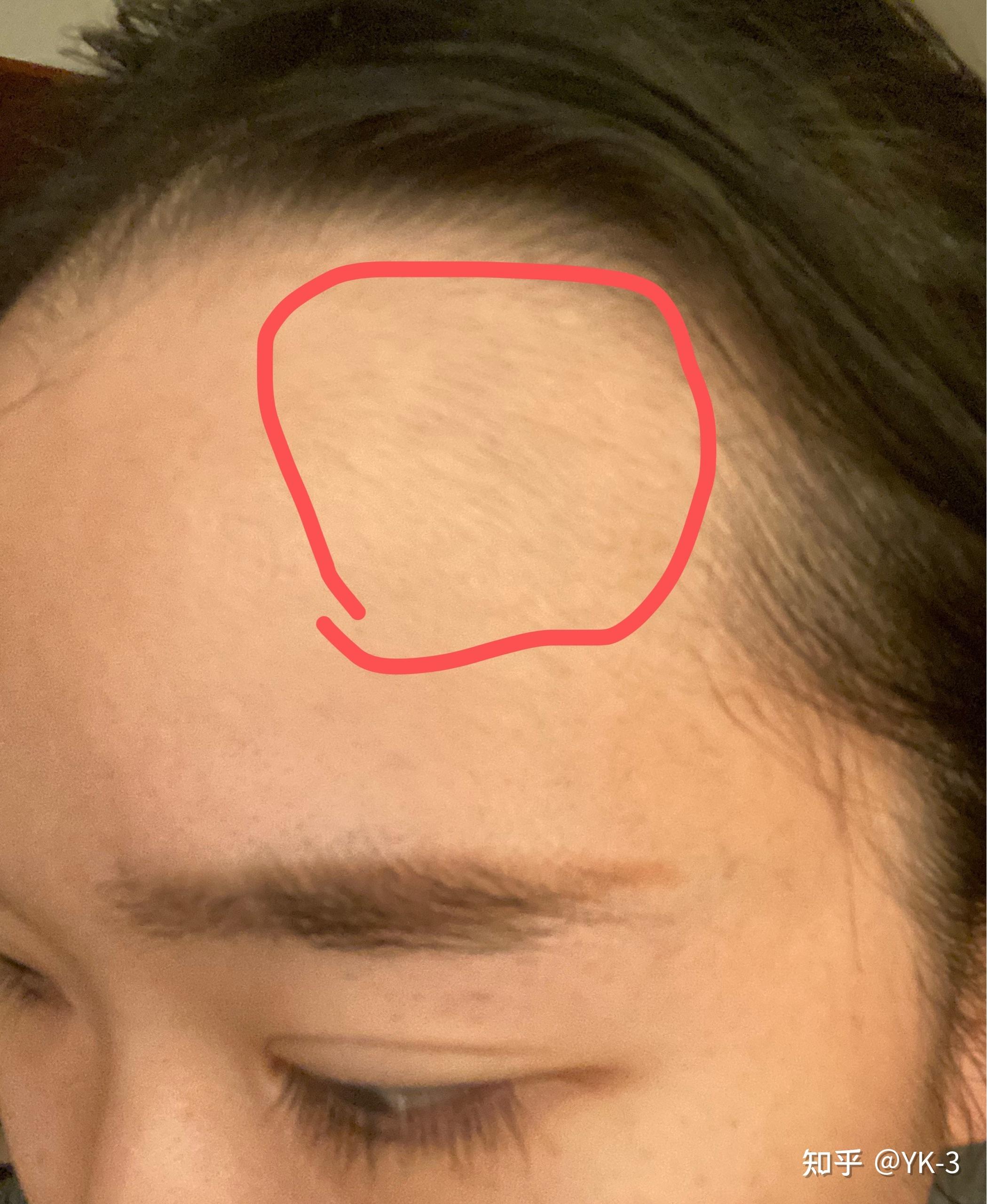 柳屋生发液不小心倒额头上了会不会额头长绒发