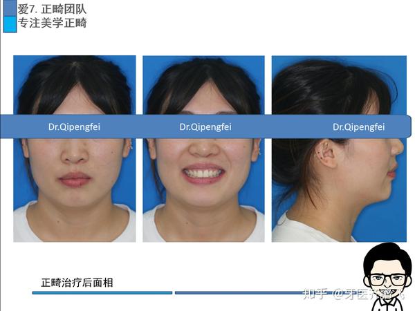 郑州牙齿矫正-双颌前突(上颌发育过度,下颌发育不足)矫正案例