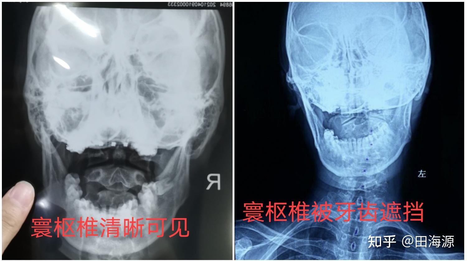张口位x光片,拍片的时候不要仰头也不要低头,尽量张大嘴让寰枢椎露
