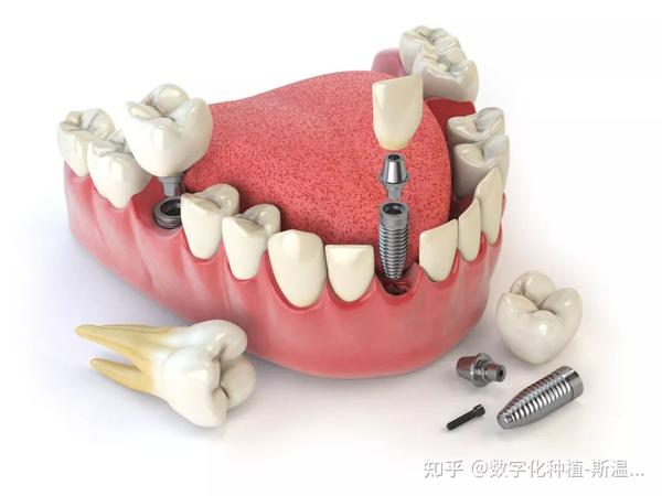 ①种植牙结构 ②种植牙手术分期 根据骨量,口腔情况等,种植牙一般分