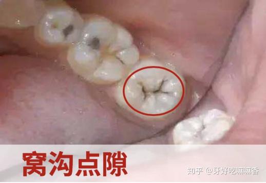 此时,如果牙面上的菌斑和残渣被清洁干净,原有致病条件发生变化,龋病