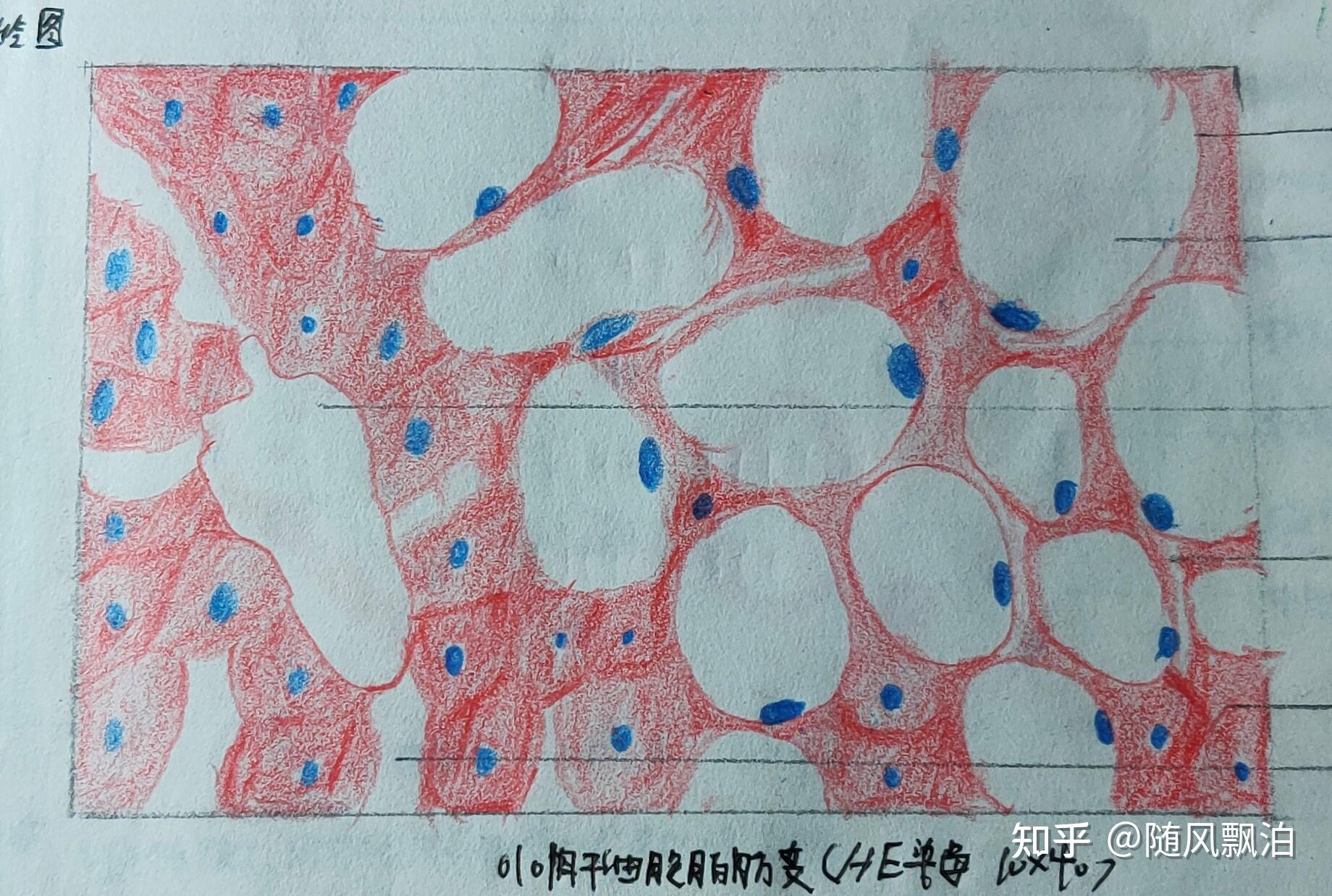 细胞脂肪变形(此图十分简单无需多言)以下包含肝细胞脂肪变 肉芽组织