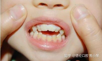 地包天牙齿矫正最佳时期是何时