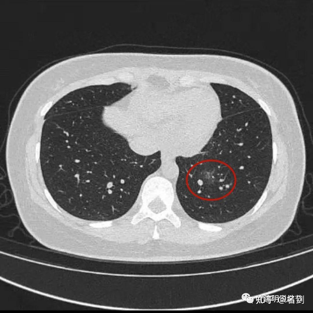 检查发现左下叶约12毫米的肺磨玻璃病灶,建议靶扫描患者某女,今年44