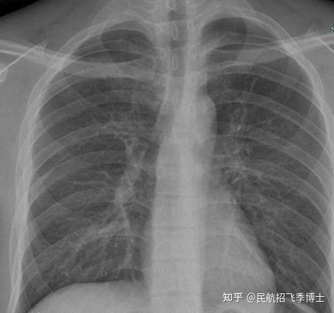 在正常时,下肺野肺纹理比上肺野多而粗,而右下肺野肺纹理比左下肺野多