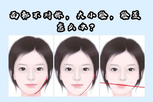 面部不对称大小脸脸歪怎么改善对症分析