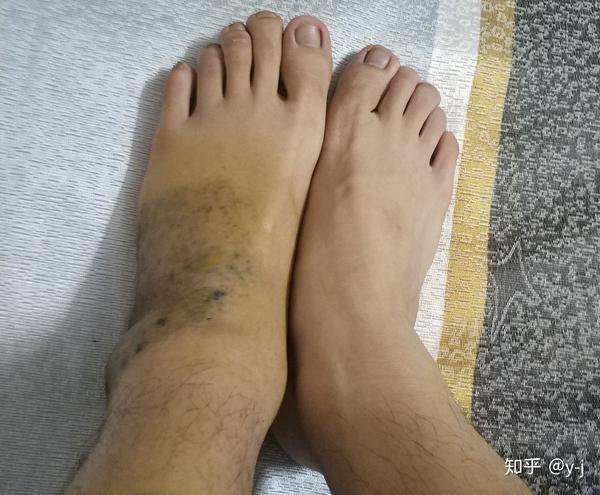 脚踝扭伤后如何的正确处理敷中药的效果如何