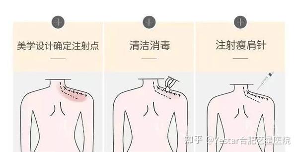 原理都是相同 只是注射部位和用量不一样而已 瘦肩针  是通过注射肉毒