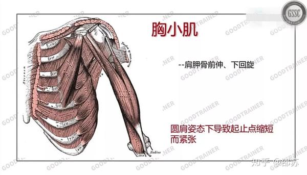 2,紧张的肌肉:胸小肌,胸锁乳突肌和前斜角肌