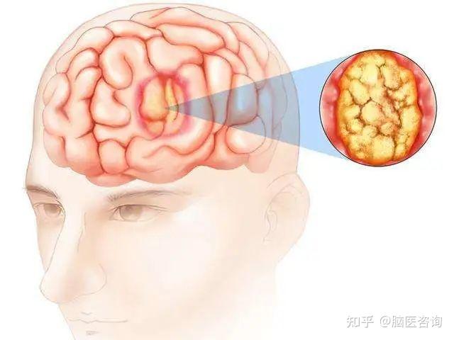 什么是胶质性脑瘤 zhuanlan.zhihu.com