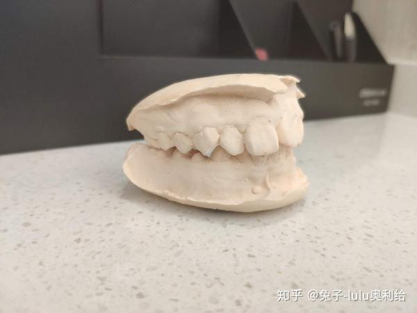 小虎牙 小龅牙的牙齿模型