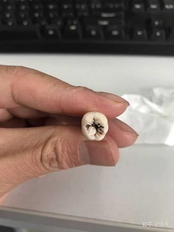 近距离看龋齿