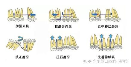 三,打骨钉疼不疼?