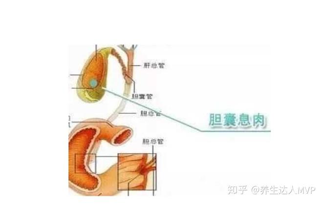 胆囊息肉是怎么引起的