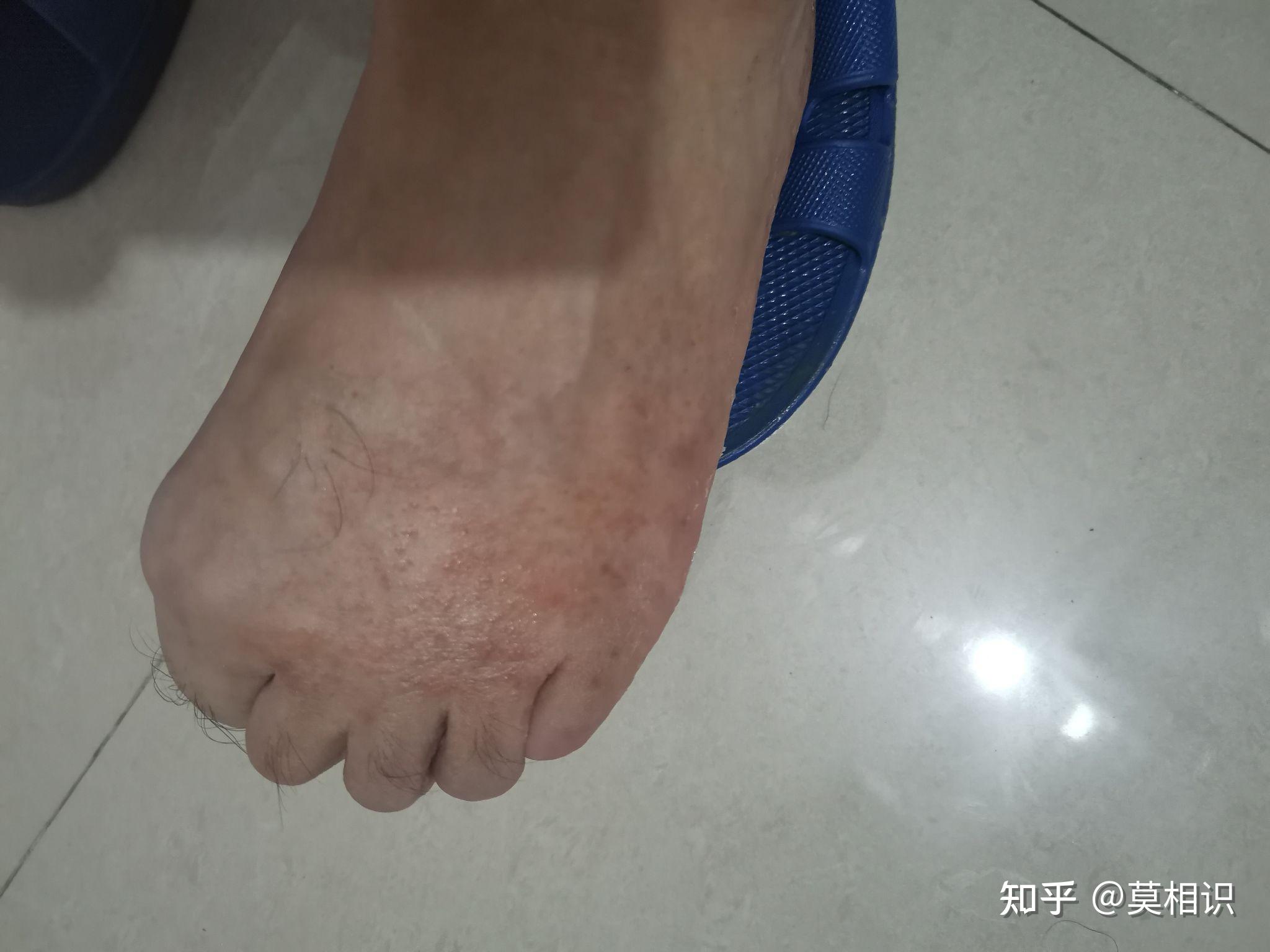 关于脚背湿疹水泡治疗过程分享