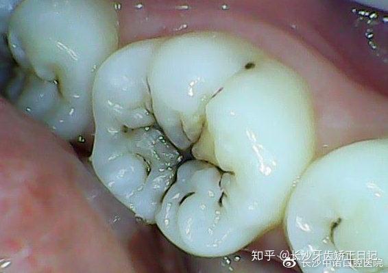 沟是不易清洁的,在窝沟发生龋坏后,是从侧面开始(与牙釉质和密度决定)