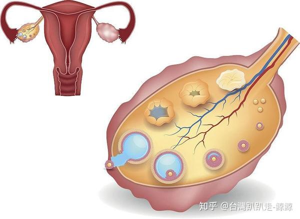 进行卵巢手术后,要特别注意早衰症状