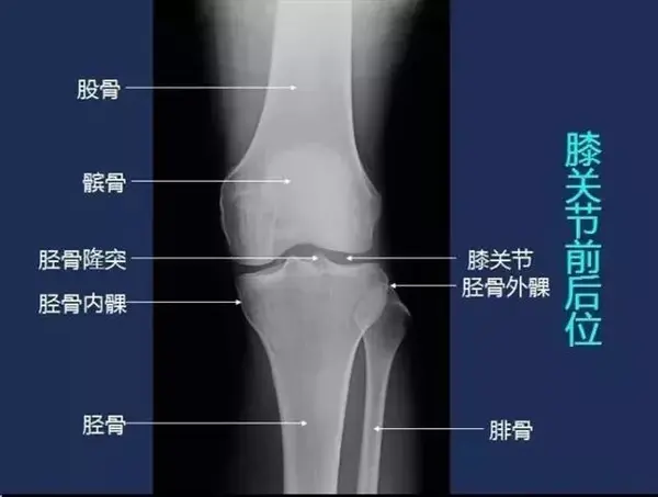 髌骨上连人体最强大的肌肉——股四头肌,下连胫骨前侧,通过肌肉的