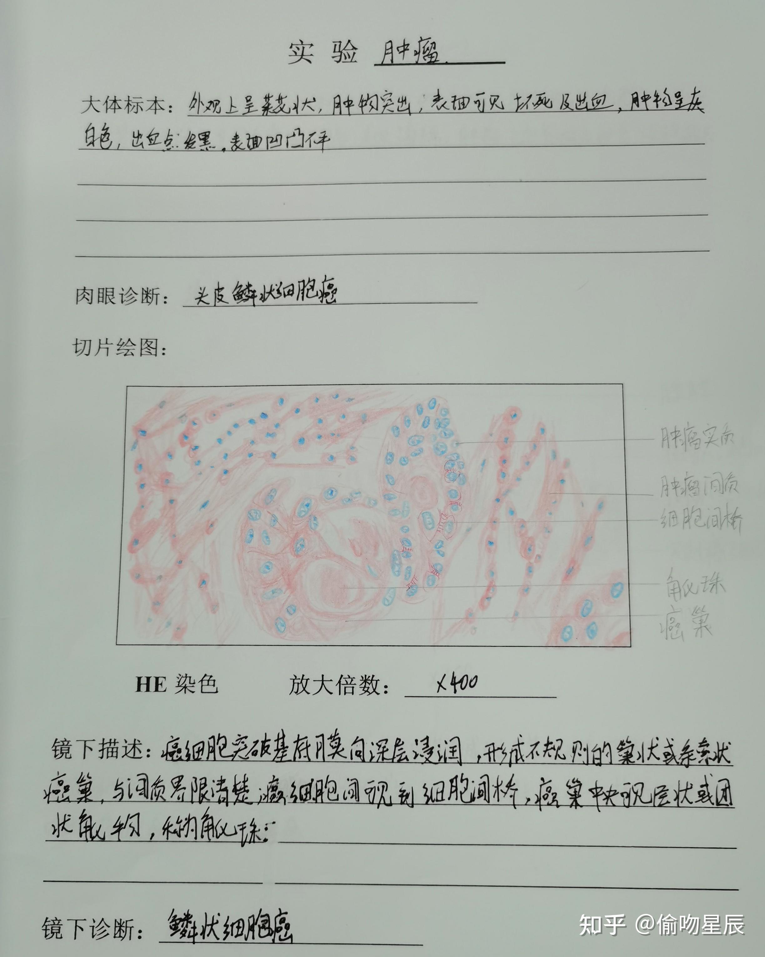 有没有人有病理的结肠腺癌红蓝铅笔手绘图啊