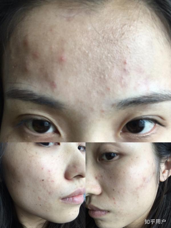 轻度痤疮患者有必要服用泰尔丝吗?