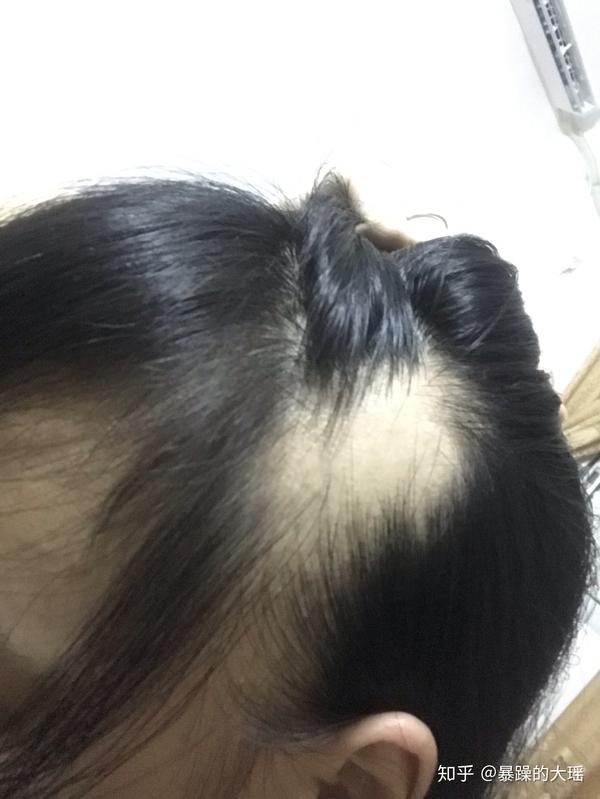 头顶有一个硬币大的斑秃,隔几天又发现左脑门也秃了一块,头发也是开始