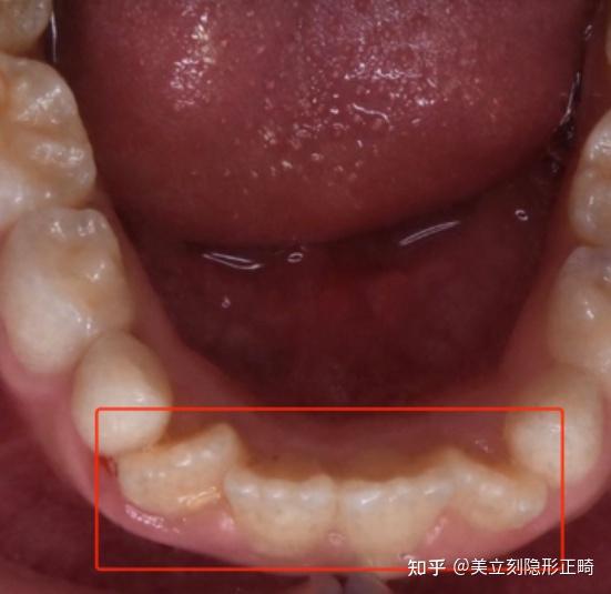 解释:上颌侧切牙萌出时,牙冠向两侧倾斜.