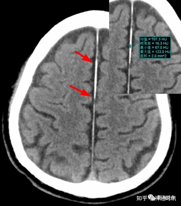 这一例大脑镰局部钙化就更加明显了,成熟的钙化部分密度要明显高于