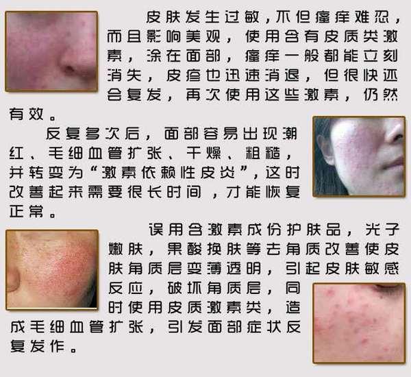 怎么知道自己是不是激素脸建议你花几分钟看看这个