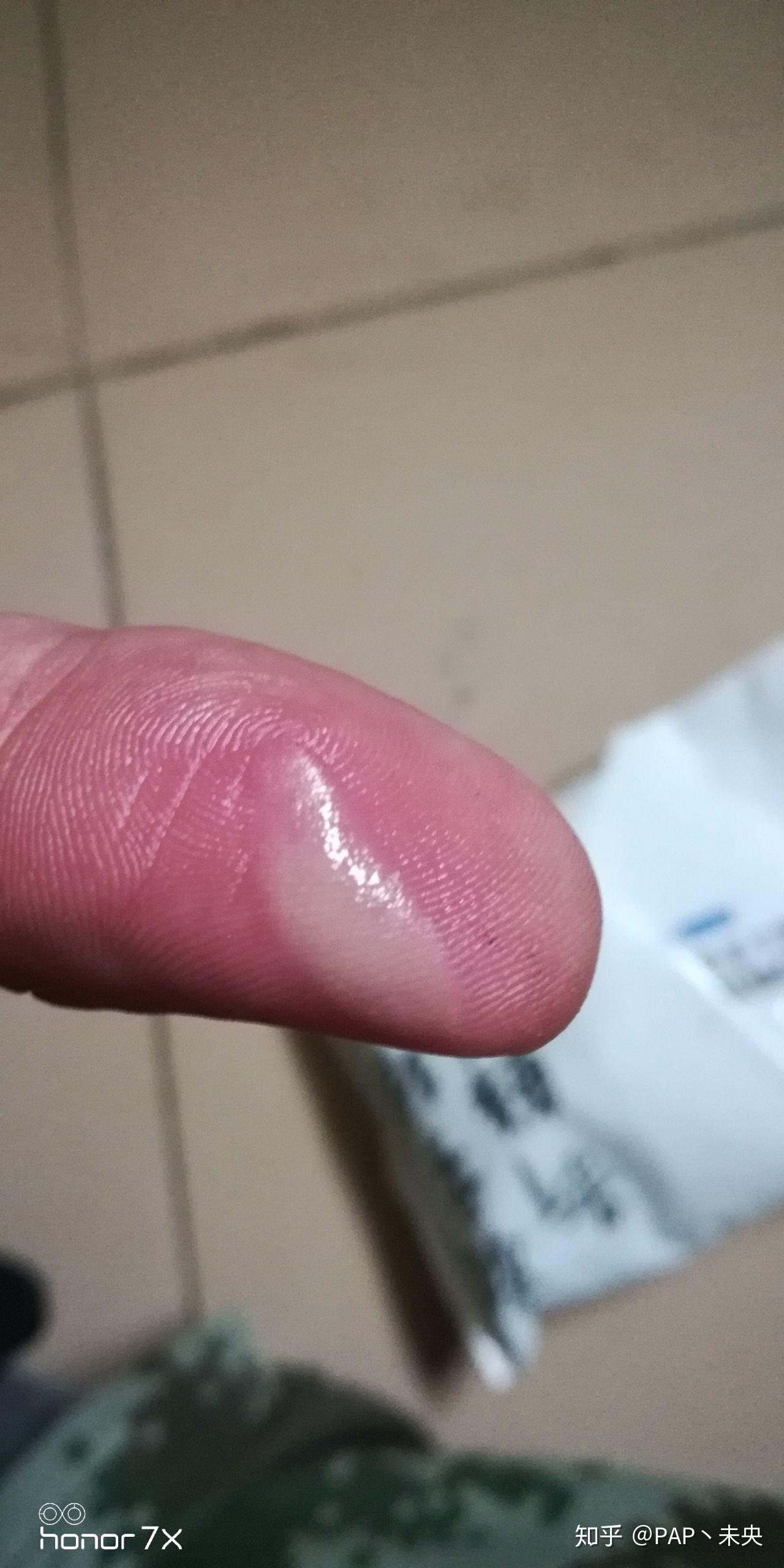 被电烙铁烫伤是一种什么样的体验怎么处理不易留疤