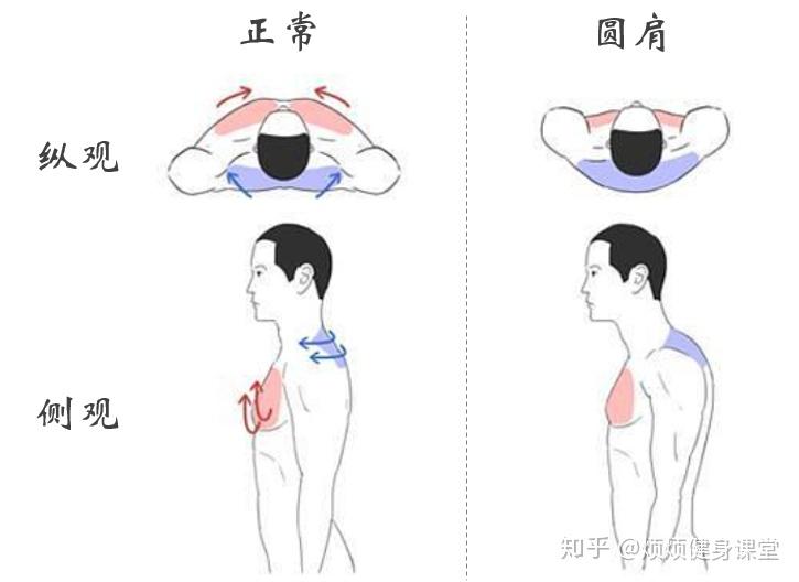 圆肩的典型特征 圆肩也叫溜肩,是一种含胸塌背的状态,指双肩向前内收