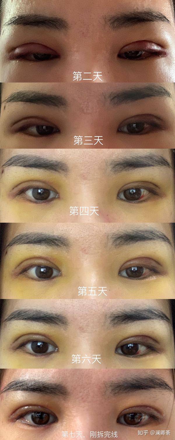 得不到的永远在骚动——割双眼皮