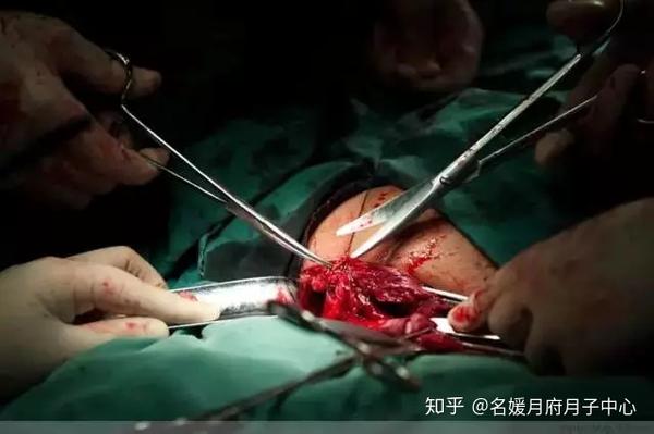 100张剖腹产全过程照片手术神秘莫测背后的真实写照