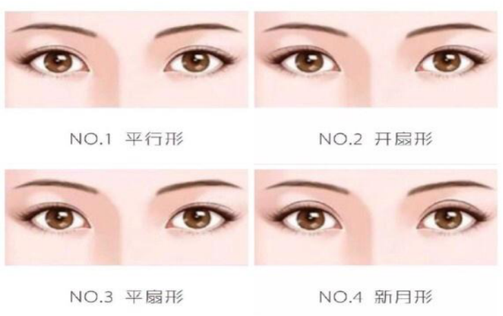 平扇型双眼皮:号称"最自然的双眼皮",其形状介于平行形和开扇形中间.