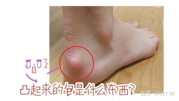那我们正常人的脚后跟是什么样的呢?