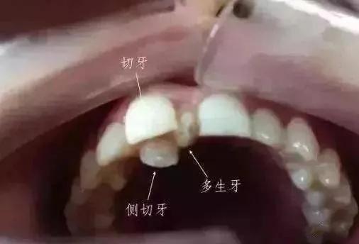 【修正数字口腔】12岁前必须处理的20种儿童牙颌畸形你知道吗?