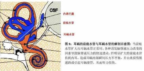 一图教你读懂"大前庭导水管"的解剖及生理