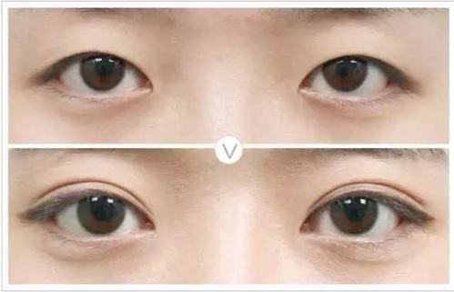 单眼皮可以变成双眼皮 单眼皮可以很容易就变成双眼皮.