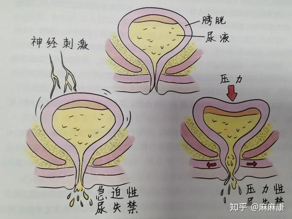 产后尿失禁怎么办这3种办法值得收藏再也不用担心漏尿尴尬了