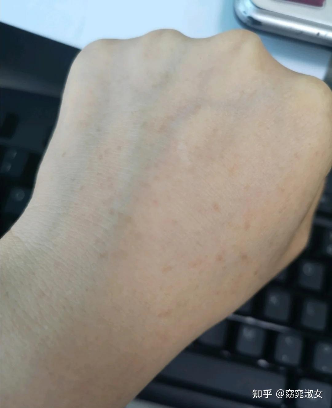 还有我本人,虽然脸上不长斑,但是我年纪轻轻的手上长斑:要知道我妈之