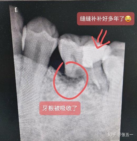 9月上旬,左侧一颗松动的乳牙,牙疼,医生说乳牙牙根已经被吸收了,于是