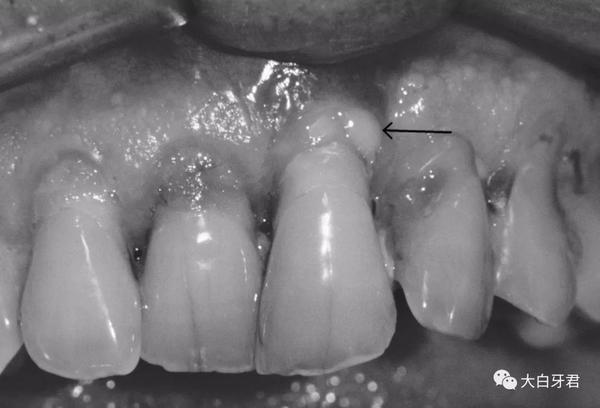 箭头所指即是牙周溢脓.(图片可能造成不适,故转成黑白)