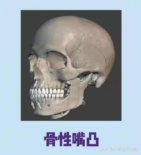 拍片才能确定是颌骨还是牙齿 导致的 嘴凸