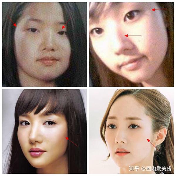 △朴敏英的主要问题:单眼皮小眼睛,太阳穴凹陷,割双眼皮,填充后流畅