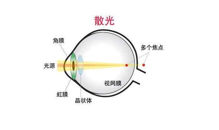 怎么区分眼睛散光和眩光