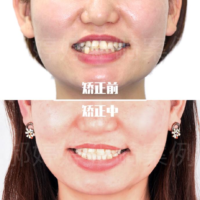 上海牙齿矫正牙齿的排列美矫正牙齿不齐案例