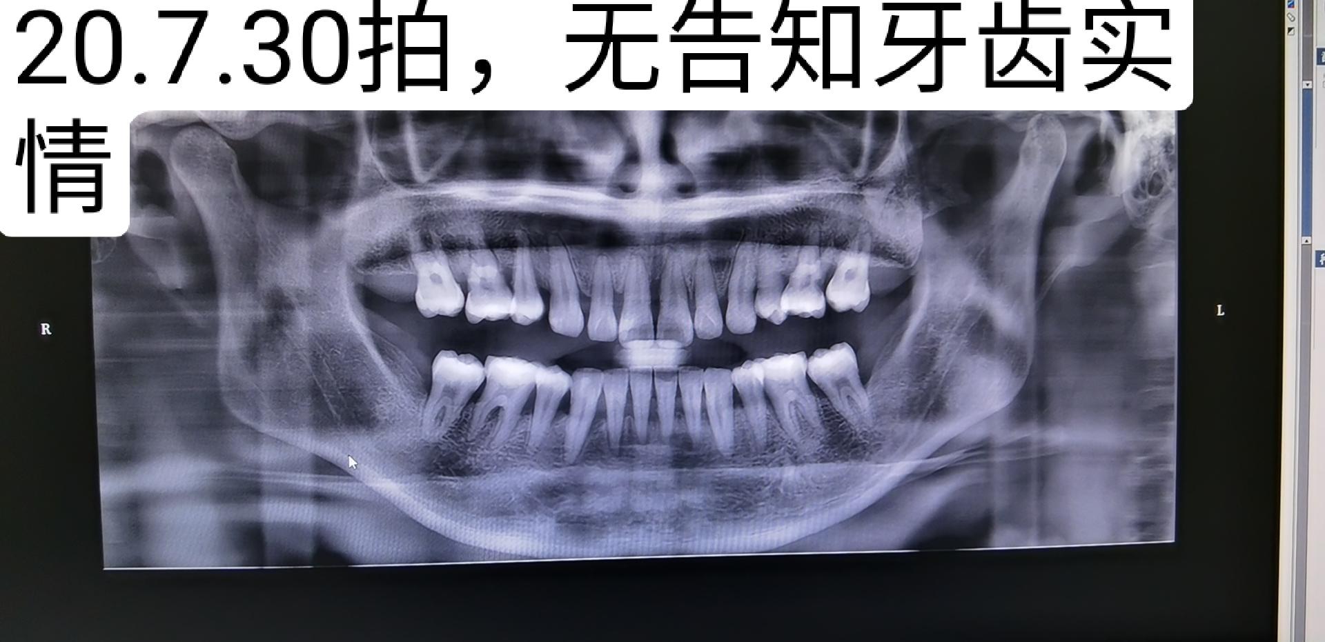 30日,不知道第多少次和郑医生反应牙周溢脓的事,终于带我去拍了全景片