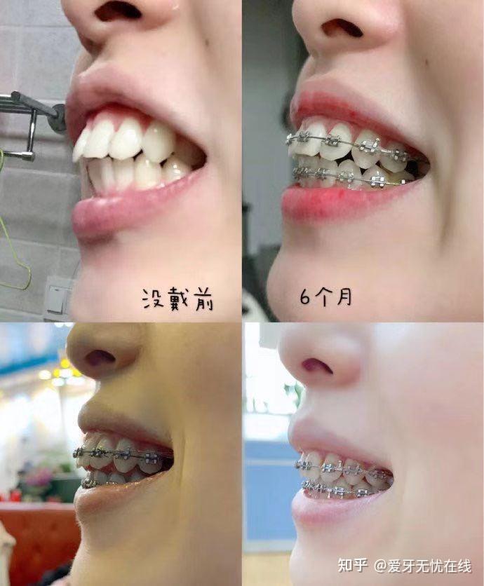 在深圳有什么是牙齿矫正(正畸)后才发现的事?矫正牙齿