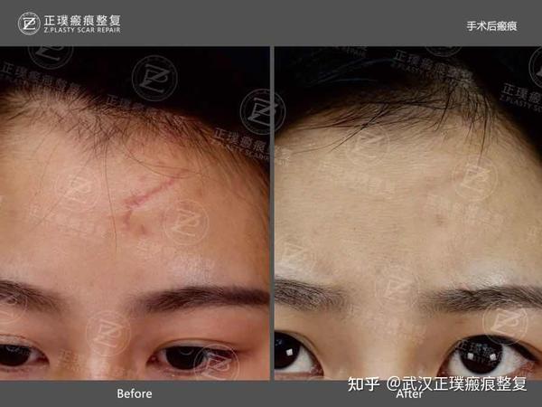 正璞瘢痕修复|疤痕有哪些类型?