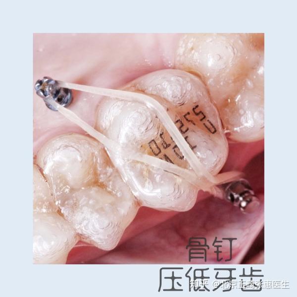 北京牙齿矫正丨正畸治疗中为什么需要使用支抗钉(骨钉